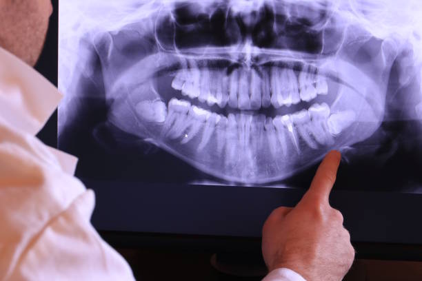 Best Knocked-Out Tooth (Avulsed Tooth) Treatment in Roxana, IL